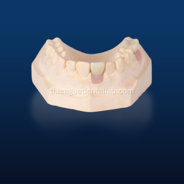 Ang Lithium ay nag -disilicate ng CAD dental implant pagpapanumbalik